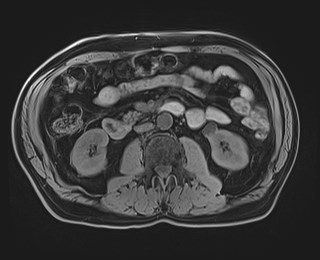 Cecal mass causing appendicitis (Radiopaedia 59207-66532 Axial T1 67).jpg