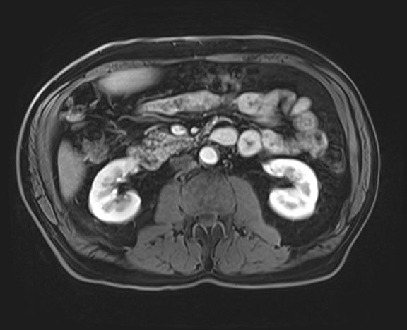 Cecal mass causing appendicitis (Radiopaedia 59207-66532 H 65).jpg