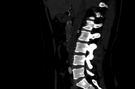 File:Celiac artery compression syndrome (Radiopaedia 47538-52152 B 9).jpg