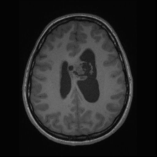 File:Central neurocytoma (Radiopaedia 37664-39557 Axial T1 49).png