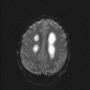 Central neurocytoma (Radiopaedia 56690-63469 Axial DWI 16).jpg