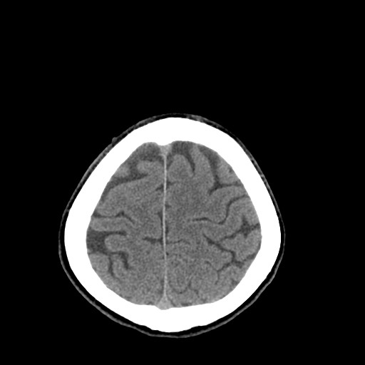 Central neurocytoma (Radiopaedia 68725-78432 Axial non-contrast 46).jpg