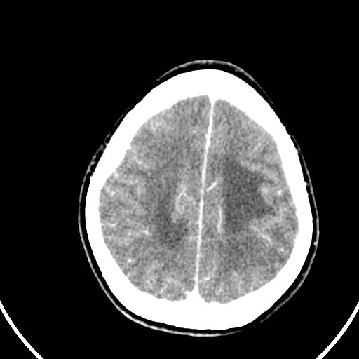 Central neurocytoma (Radiopaedia 84497-99871 B 39).jpg