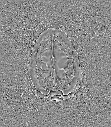 Central neurocytoma (Radiopaedia 84497-99872 Axial 67).jpg