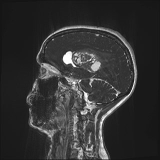 Central neurocytoma (Radiopaedia 84497-99872 Sagittal CISS 27).jpg