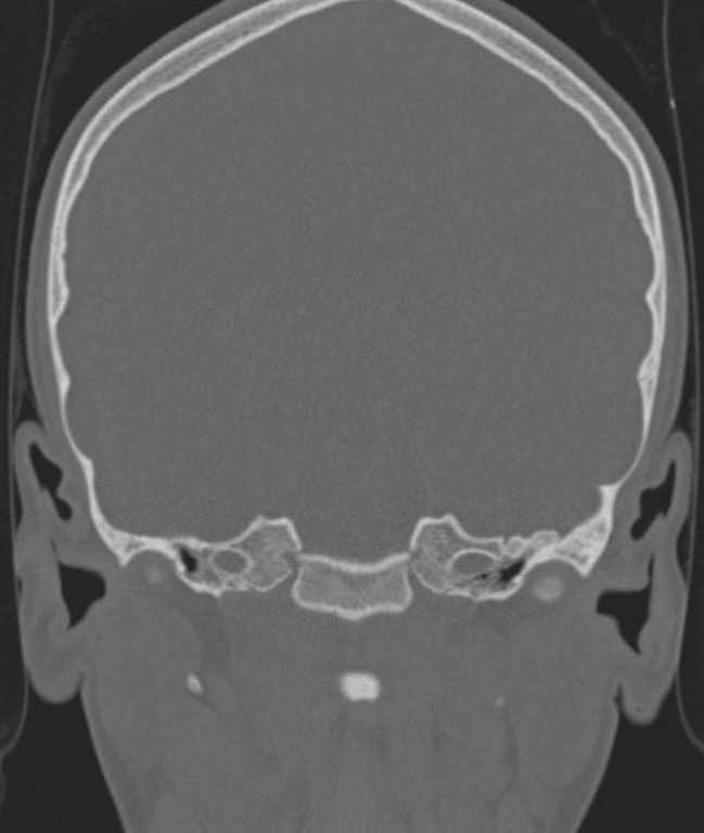 Cerebellar abscess (Radiopaedia 73727-84527 Coronal bone window 80).jpg