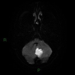 Cerebellar abscess (Radiopaedia 78135-90678 Axial DWI 8).jpg