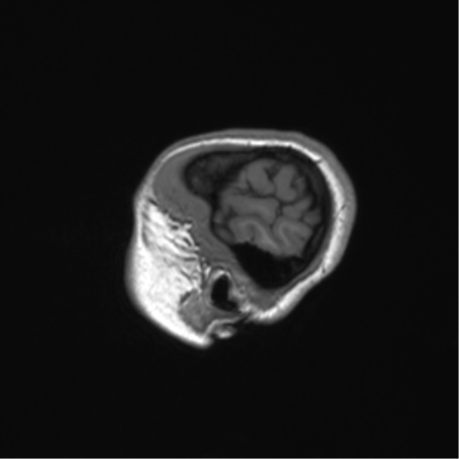 Cerebellar agenesis with hypoplastic pons (pontocerebellar hypoplasia) (Radiopaedia 57224-64138 Sagittal T1 13).png