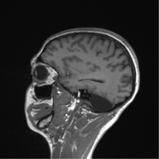Cerebellar agenesis with hypoplastic pons (pontocerebellar hypoplasia) (Radiopaedia 57224-64138 Sagittal T1 24).png