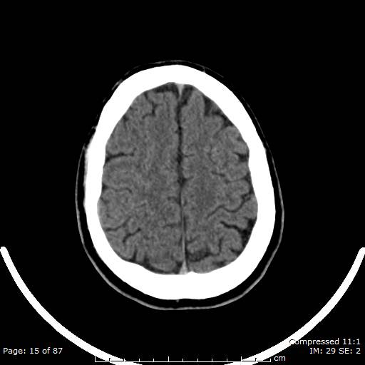Cerebellar hemangioblastoma (Radiopaedia 52360-58258 Axial non-contrast 15).jpg