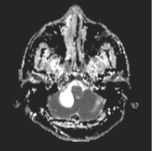 File:Cerebellar hemangioblastomas and pituitary adenoma (Radiopaedia 85490-101176 Axial ADC 5).png