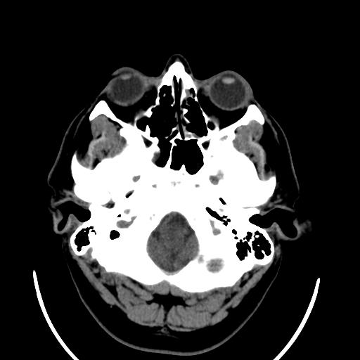 File:Cerebellar infarction (Radiopaedia 16625-16327 Axial non-contrast 7).jpg