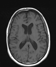 File:Cerebellar metastasis (Radiopaedia 54578-60810 Axial T1 22).png