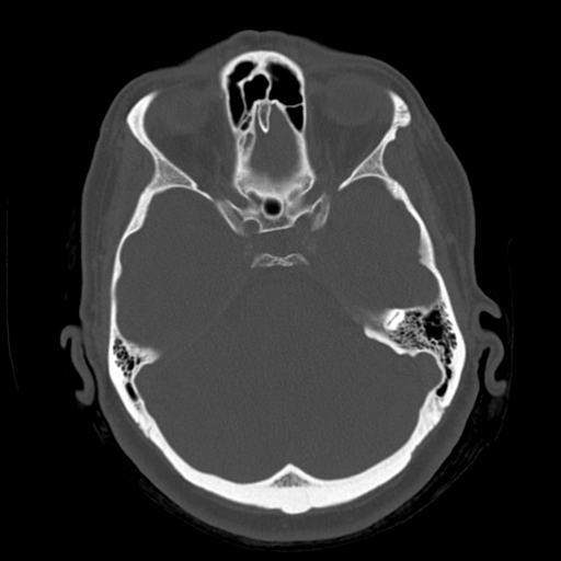 Cerebellar metastasis (cystic appearance) (Radiopaedia 41395-44258 Axial bone window 20).png