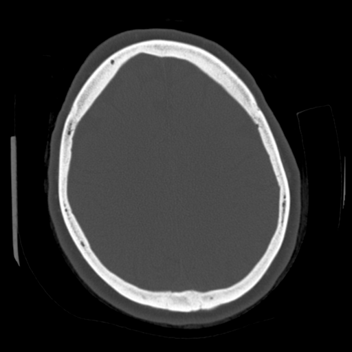 Cerebellar metastasis (cystic appearance) (Radiopaedia 41395-44258 Axial bone window 50).png