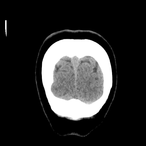 File:Cerebellar metastasis (cystic appearance) (Radiopaedia 41395-44258 Coronal non-contrast 57).png