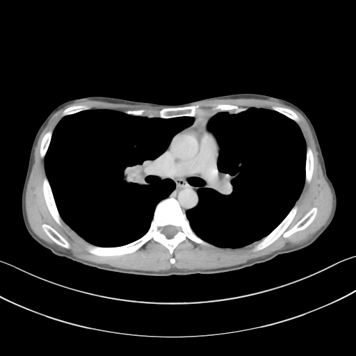 Cerebellar metastasis - adenocarcinoma lung (Radiopaedia 63184-71717 Axial C+ delayed 31).png