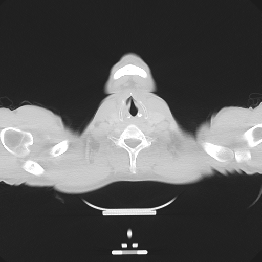 Cerebellar metastasis - adenocarcinoma lung (Radiopaedia 63184-71717 Axial lung window 2).png