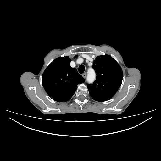 Cerebellar metastasis - lung tumor (Radiopaedia 69317-79150 A 7).jpg