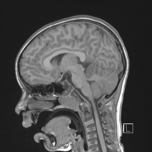 Cerebellar stroke (Radiopaedia 32202-33150 Sagittal T1 C+ 24).png