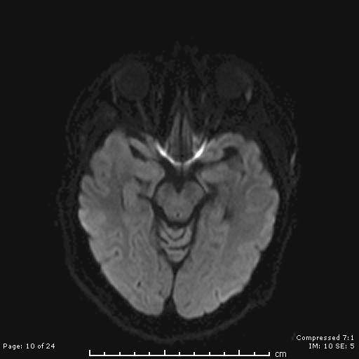 File:Cerebellar strokes due to intracranial giant cell arteritis (Radiopaedia 68799-81713 Axial DWI 10).jpg