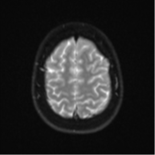 Cerebellar tuberculomas (Radiopaedia 46939-51472 Axial DWI 24).png