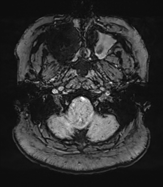Cerebellopontine angle meningioma (Radiopaedia 48434-53348 Axial SWI 10).png
