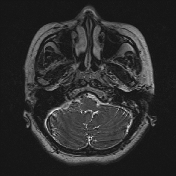 Cerebellopontine angle meningioma (Radiopaedia 53561-59591 Axial 3D volume T2 35).jpg