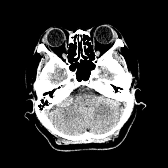 File:Cerebellopontine angle meningioma (Radiopaedia 53561-59592 Axial non-contrast 15).jpg