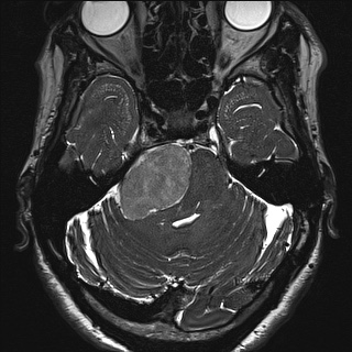 Cerebellopontine angle meningioma (Radiopaedia 72983-83680 Axial FIESTA 40).jpg