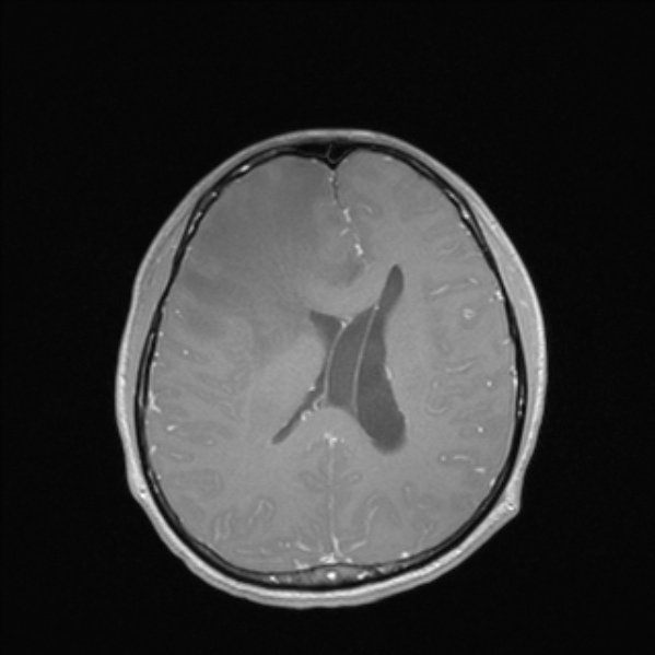 Cerebral abscess (Radiopaedia 24212-24478 Axial T1 C+ 38).jpg