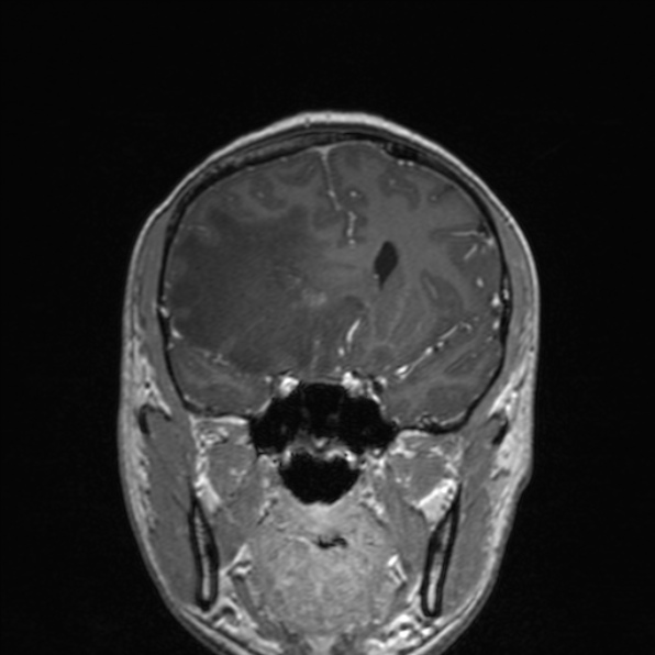 Cerebral abscess (Radiopaedia 24212-24478 Coronal T1 C+ 87).jpg