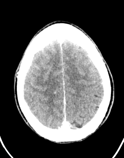 Cerebral abscess (Radiopaedia 60342-68008 Axial C+ delayed 41).png