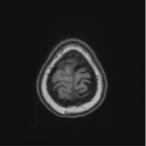 File:Cerebral abscess from pulmonary arteriovenous malformation (Radiopaedia 86275-102291 Axial T1 69).png