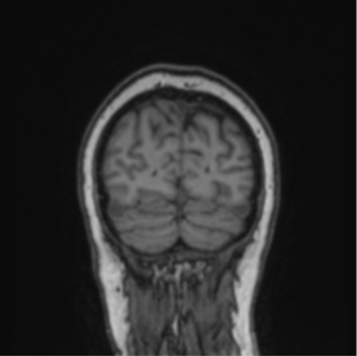 Cerebral abscess from pulmonary arteriovenous malformation (Radiopaedia 86275-102291 Coronal T1 17).png