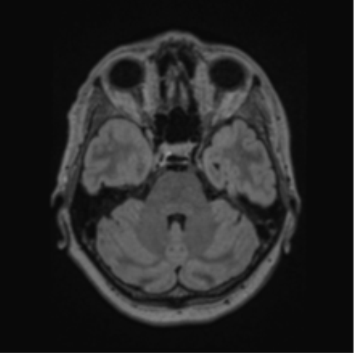 Cerebral abscess from pulmonary arteriovenous malformation (Radiopaedia 86275-102291 J 25).png