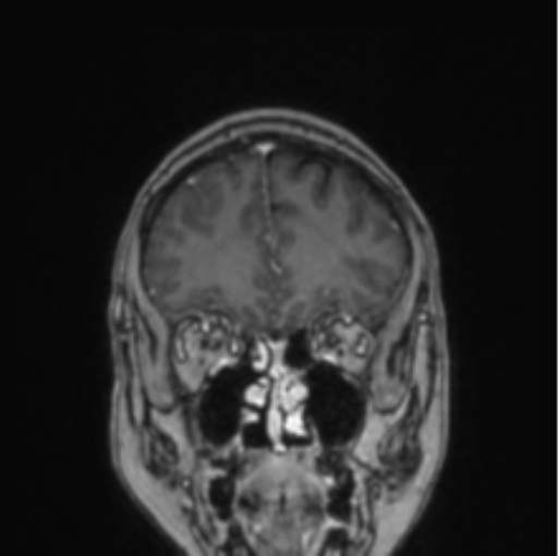 Cerebral abscess from pulmonary arteriovenous malformation (Radiopaedia 86275-102291 L 69).png
