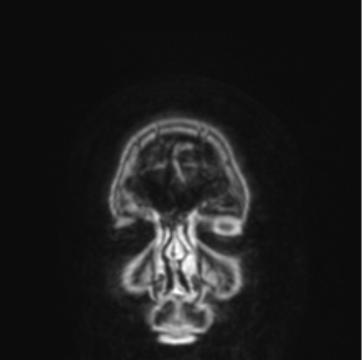 Cerebral abscess from pulmonary arteriovenous malformation (Radiopaedia 86275-102291 L 86).png
