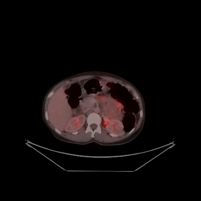 Cerebral and abdominal tuberculosis (Radiopaedia 90499-107853 C 153).jpg