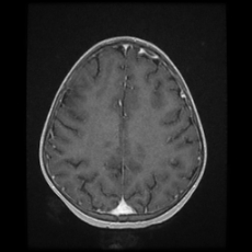 Cerebral and spinal tuberculosis (Radiopaedia 90489-107837 Axial T1 C+ 138).jpg