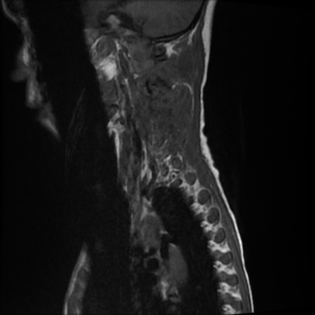 File:Cerebral and spinal tuberculosis (Radiopaedia 90489-107838 Sagittal T1 12).jpg