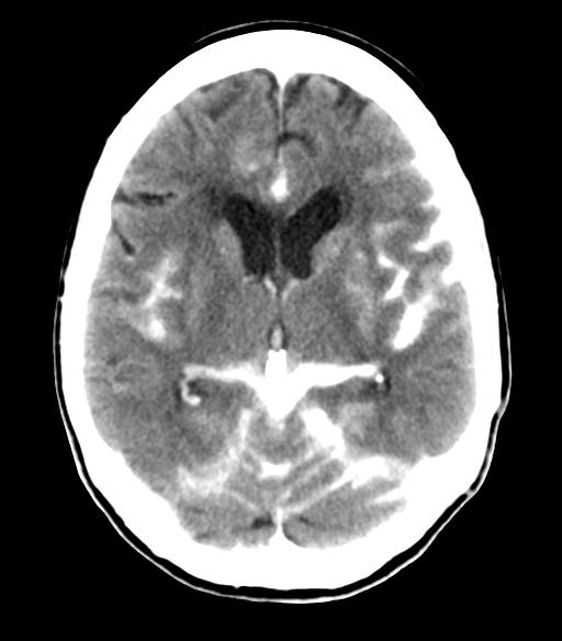 File:Cerebral aneurysm with rupture (Radiopaedia 29933-30460 Axial non-contrast 13).jpg