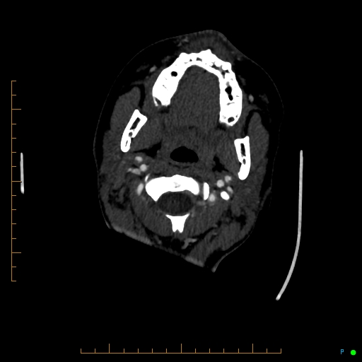Cerebral arteriovenous malformation (AVM) (Radiopaedia 78162-90706 Axial CTA 17).jpg