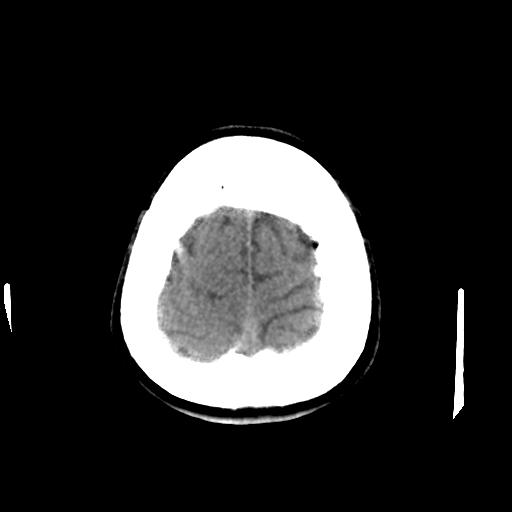 Cerebral arteriovenous malformation (Radiopaedia 28518-28759 Axial non-contrast 66).jpg