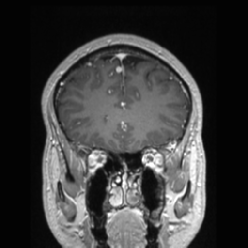 Cerebral arteriovenous malformation (Radiopaedia 39259-41506 Coronal T1 C+ 70).png