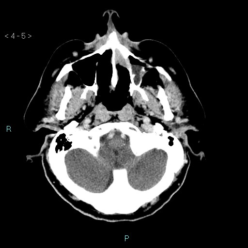 File:Cerebral arteriovenous malformation (Radiopaedia 40528-43125 Axial C+ delayed 5).jpg