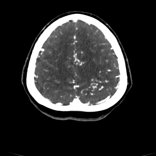 Cerebral arteriovenous malformation (Radiopaedia 73830-84645 Axial C+ delayed 16).jpg