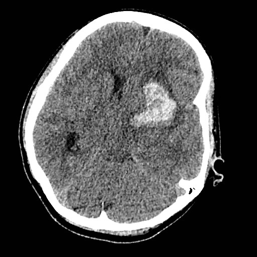 Cerebral arteriovenous malformation (Radiopaedia 79677-92887 Axial non-contrast 16).jpg
