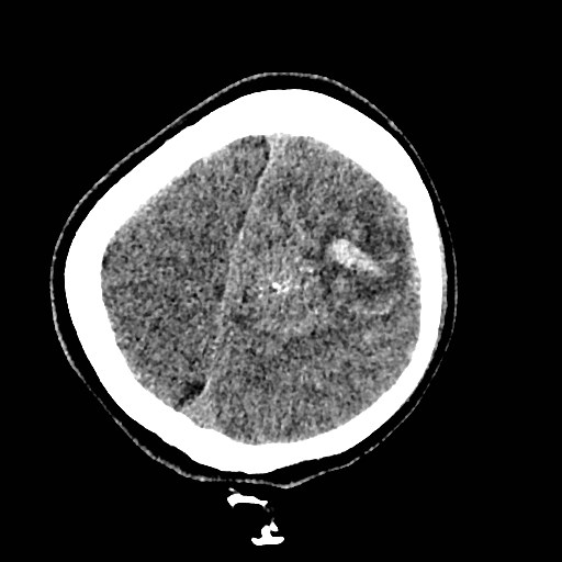 Cerebral arteriovenous malformation (Radiopaedia 79677-92887 Axial non-contrast 43).jpg