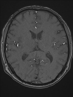 Cerebral arteriovenous malformation (Radiopaedia 84015-99245 Axial TOF 136).jpg